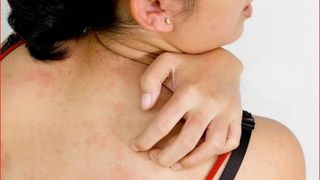 Dermatomiozita. Boala autoimuna dermatomiozita. Ce este dermatomiozita. Simptome dermatomiozita.