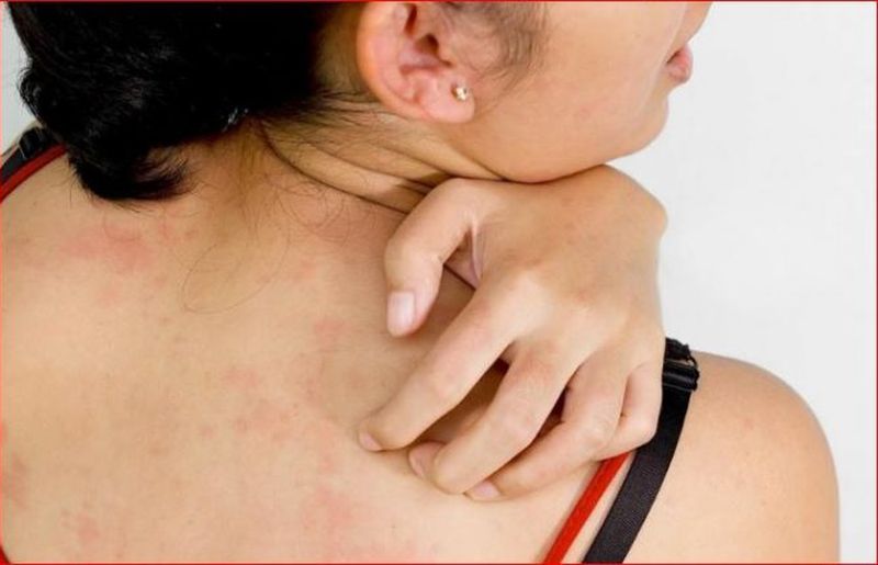 Dermatomiozita. Boala autoimuna dermatomiozita. Ce este dermatomiozita. Simptome dermatomiozita.