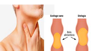 Disfagia cauze simptome tratament - dificultați la inghitire