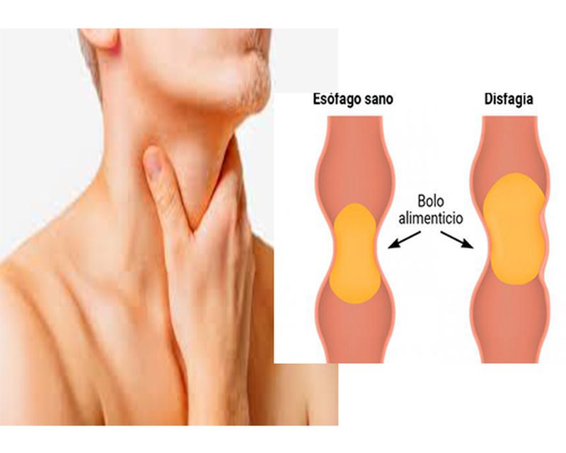 Disfagia cauze simptome tratament - dificultați la inghitire