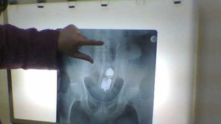 Un tânăr a ajuns de urgență la spital după ce i-a intrat deodorantul într-o zonă mai puțin obișnuită