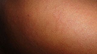 Rujeola lovește Rom&acirc;nia. 20.000 de cazuri confirmate, dar și 64 de decese