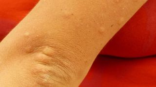 Primăria Capitalei anunţă că tratamentele pentru combaterea ţ&acirc;nţarilor vor &icirc;ncepe &icirc;n 5 mai