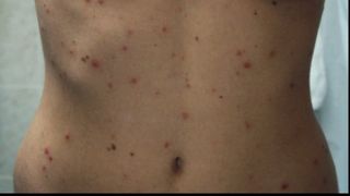 Epidemia de rujeolă face ravagii &icirc;n Rom&acirc;nia: 20.000 de cazuri și 64 de decese