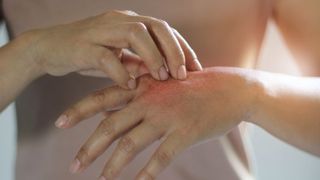 Psoriazis. Cauza psoriazis. Psoriazis tratament