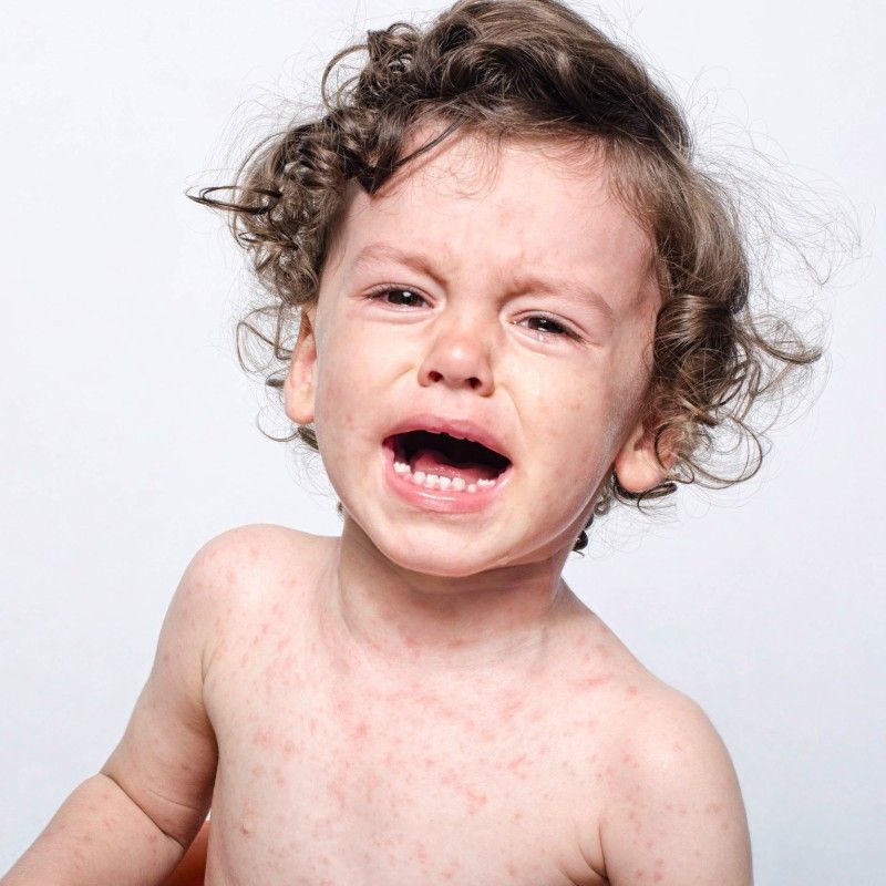 Numărul de cazuri de rujeolă din România