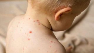 Numărul de cazuri de rujeolă din Rom&acirc;nia, &icirc;n creştere
