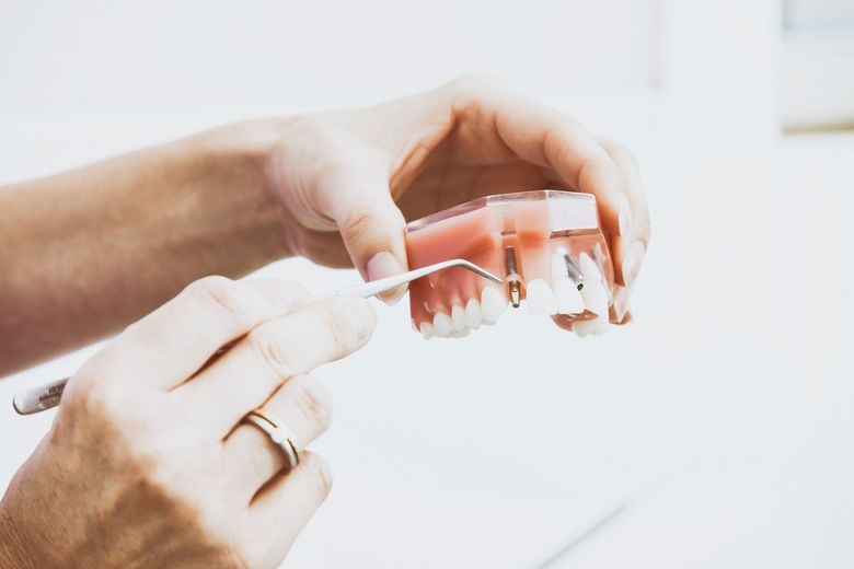 Cum îți poate îmbunătăți viața implantul dentar ?