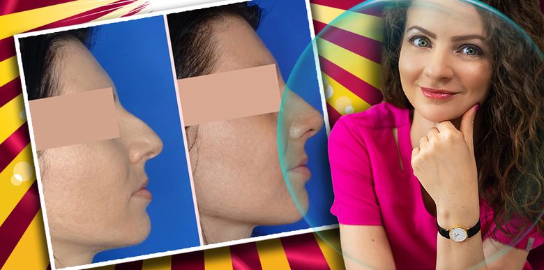 Rinoplastia, operația estetică ce modifică forma și mărimea nasului. Ce preţ are această intervenţie complexă? Rinoplastia, operația estetică ce modifică forma și mărimea nasului. Ce preţ are această intervenţie complexă?