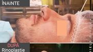 Rinoplastia este o operaţie complexă