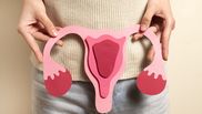 Ce este fibromul uterin