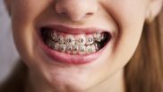Cum ne dăm seama că cel mic are nevoie de aparat dentar 