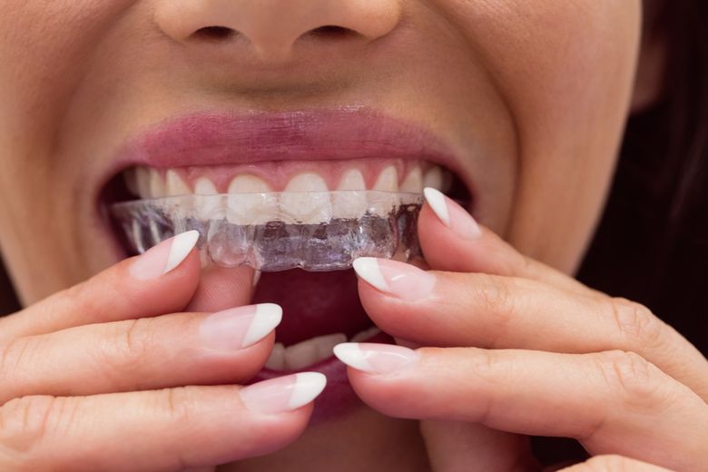 Este aparatul dentar o simplă necesitate estetică?