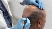 Ce este alopecia? Care sunt primele semne pe care le dă boala