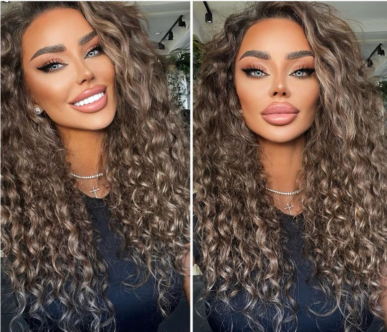 „Îmi sângerau gingiile.” Bianca Drăgușanu suferă de o boală gravă și este nevoită să își schimbe dantura