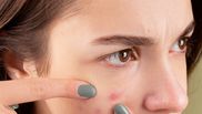dermatita de stres