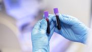 Cum se depistează infecția cu HPV