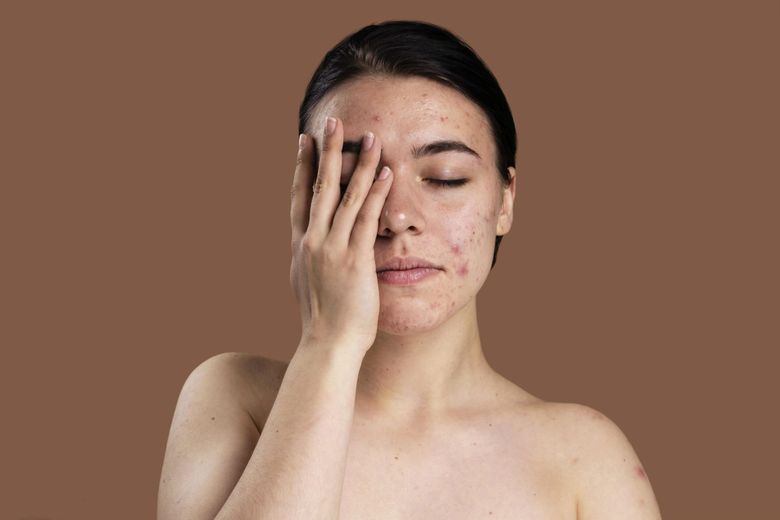 Alimente care provoacă acnee și dezechilibre hormonale