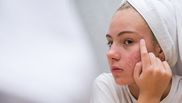 Care sunt hormonii ce favorizează apariția acneei
