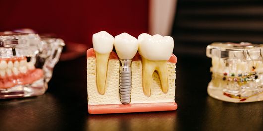 Ești in căutarea unei clinici stomatologice care are oferte la implant dentar?