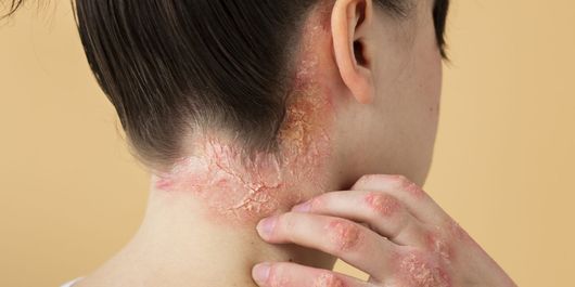 Ce este dermatita seboreică. Cauze, simptome și tratamente pentru această afecțiune cutanată