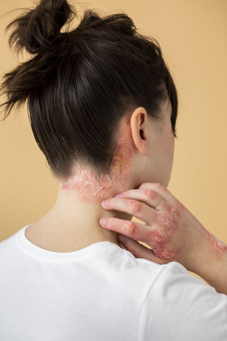 Ce este dermatita seboreică. Cauze, simptome și tratamente pentru această afecțiune cutanată
