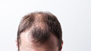 alopecia androgenica