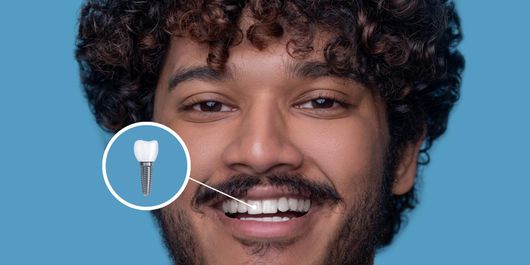Implanturile dentare: O soluție modernă pentru zâmbete durabile 