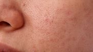 3 remedii naturale pentru pori dilatați. Trebuie să încerci numărul 2