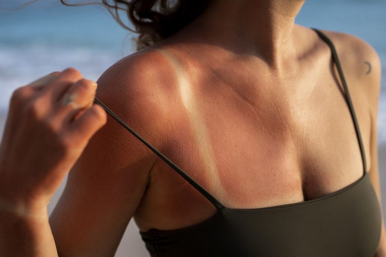 8 remedii naturiste pentru arsuri solare. Ce metode simple și rapide poți folosi pentru a-ți îngriji pielea