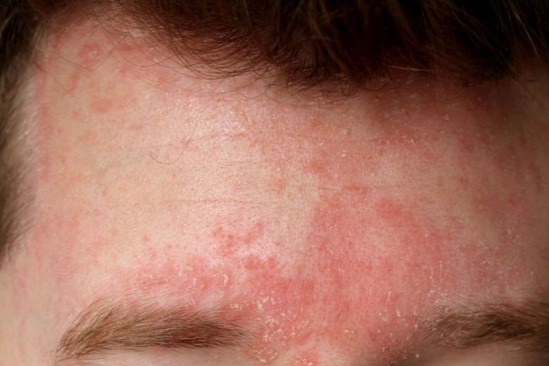 Ce este dermatita seboreică și care sunt opțiunile de tratament?