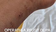 Liviu Guță- intervenție chirurgicală