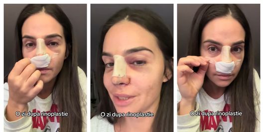 FOTO Artista Mellina, pe masa de operație! La ce procedură a recurs frumoasa vedetă, dar și cum se simte acum? 
