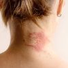 (P) Dermatita atopică: cauze, simptome, diagnosticare și tratament