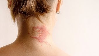 (P) Dermatita atopică: cauze, simptome, diagnosticare și tratament