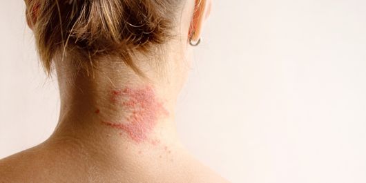 (P) Dermatita atopică: cauze, simptome, diagnosticare și tratament