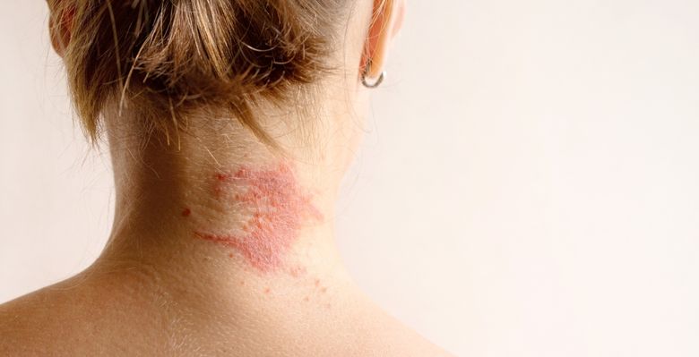 (P) Dermatita atopică: cauze, simptome, diagnosticare și tratament