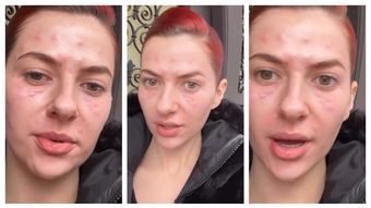 Lidia Buble, cu fața tumefiată: „Zici că mă transform într-o reptilă, ceva, vreun supererou.”