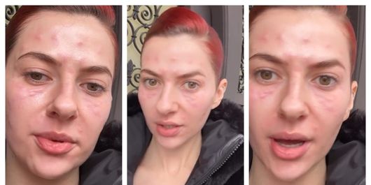 Lidia Buble, cu fața tumefiată: „Zici că mă transform într-o reptilă, ceva, vreun supererou.”