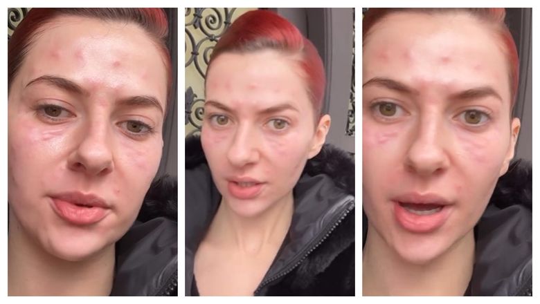 Lidia Buble, cu fața tumefiată: „Zici că mă transform într-o reptilă, ceva, vreun supererou.”