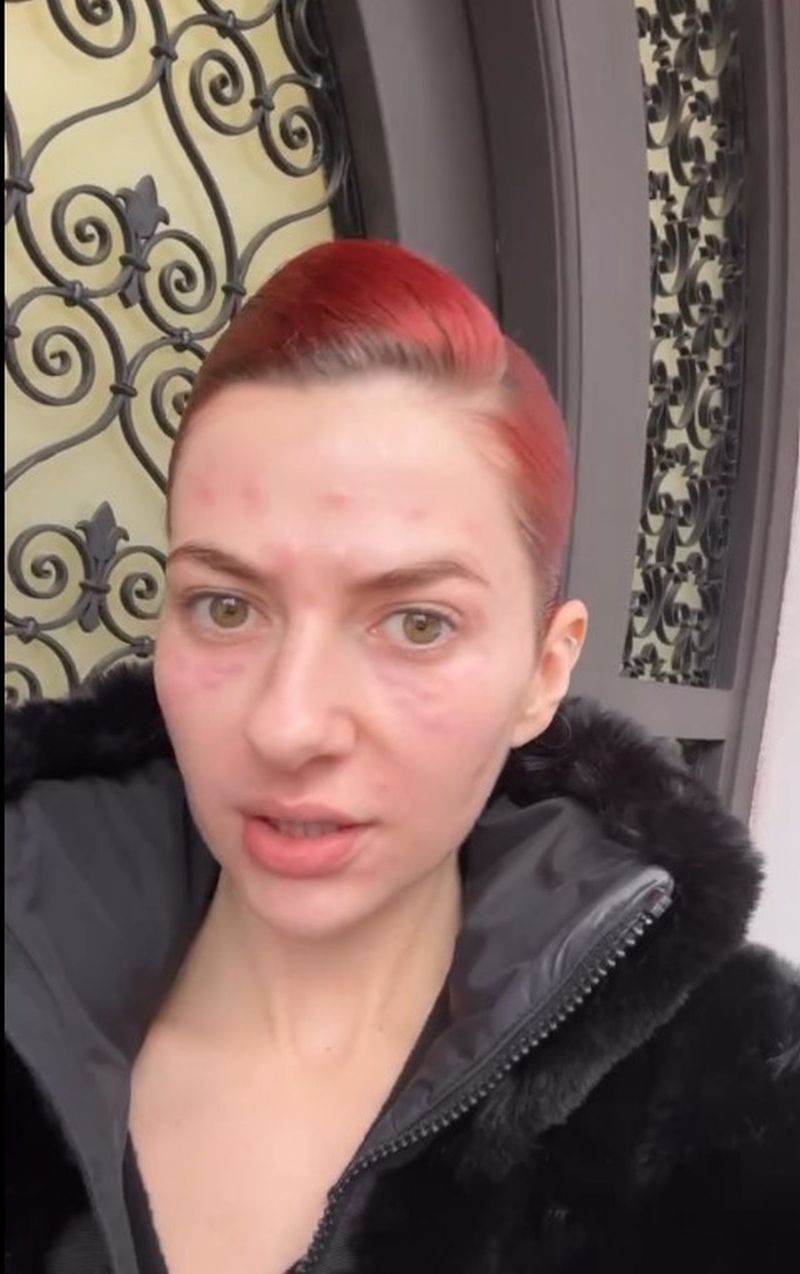 Lidia Buble a mers la tratament cosmetic