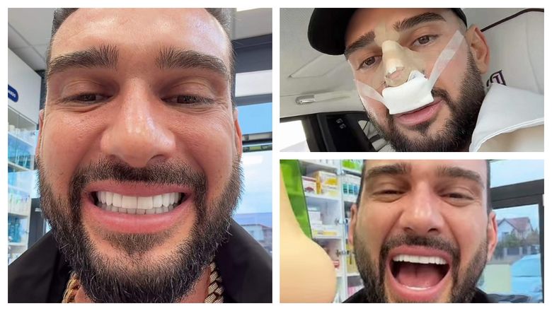 Dorian Popa mai are de așteptat până să vadă rezultatul final după operația de la nas. Cum se simte artistul în prezent: “Nu-l simt încă al meu.”