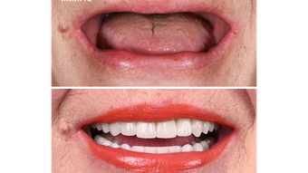 (P) Ce îi spui mamei când zice că o proteză fixă pe 4 implanturi are un preț prea mare pentru ea