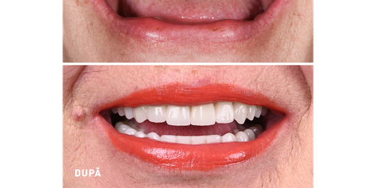 (P) Ce îi spui mamei când zice că o proteză fixă pe 4 implanturi are un preț prea mare pentru ea