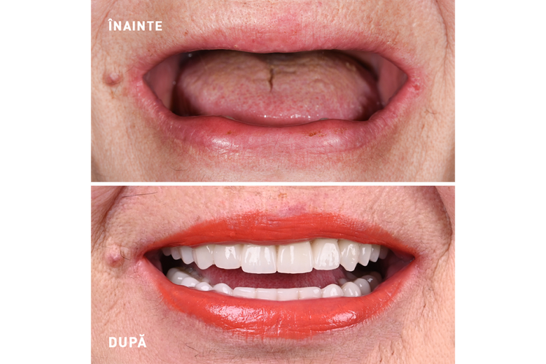 (P) Ce îi spui mamei când zice că o proteză fixă pe 4 implanturi are un preț prea mare pentru ea