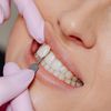 (P) Estetica Dentară Minim Invazivă: Echilibrul Perfect &Icirc;ntre Conservarea Dintelui și Investiția Financiară