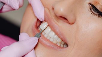 (P) Estetica Dentară Minim Invazivă: Echilibrul Perfect Între Conservarea Dintelui și Investiția Financiară