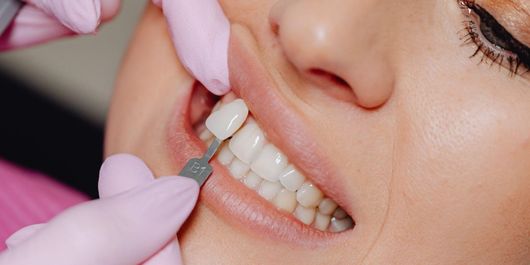 (P) Estetica Dentară Minim Invazivă: Echilibrul Perfect Între Conservarea Dintelui și Investiția Financiară