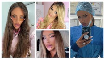Bianca Drăgușanu, pregătită pentru a treia rinoplastie. Cu ce probleme s-a confruntat vedeta până acum: „A încercat să repare.”