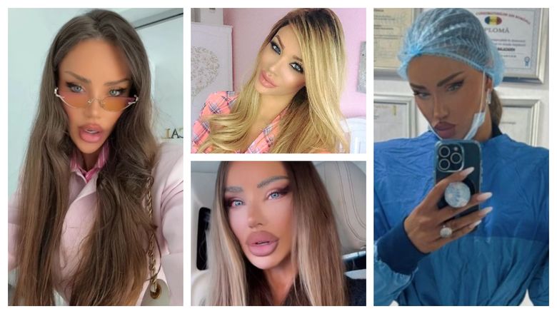 Bianca Drăgușanu, pregătită pentru a treia rinoplastie. Cu ce probleme s-a confruntat vedeta până acum: „A încercat să repare.”